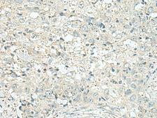 FAM116A Antibody - Immunohistochemistry of paraffin-embedded Human esophagus cancer tissue  using DENND6A Polyclonal Antibody at dilution of 1:120(×200)