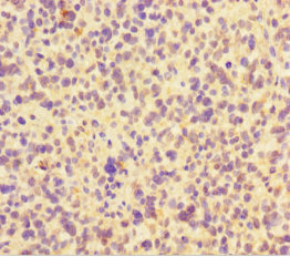 FAM117B / ALS2CR13 Antibody - Immunohistochemistry of paraffin-embedded human glioma using FAM117B Antibody at dilution of 1:100