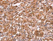 FAM123B / WTX Antibody - Immunohistochemistry of paraffin-embedded Human gastric cancer using AMER1 Polyclonal Antibody at dilution of 1:40.