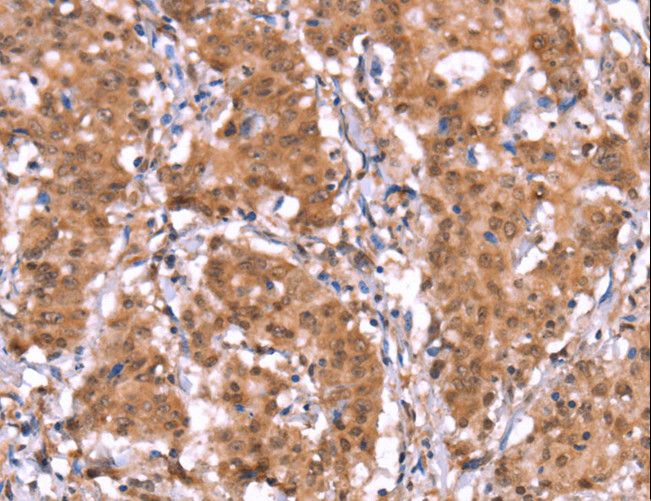 FAM123B / WTX Antibody - Immunohistochemistry of paraffin-embedded Human gastric cancer using AMER1 Polyclonal Antibody at dilution of 1:40.