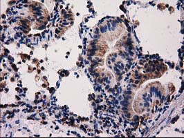 FAM127C Antibody - IHC of paraffin-embedded Carcinoma of Human lung tissue using anti-FAM127C mouse monoclonal antibody.