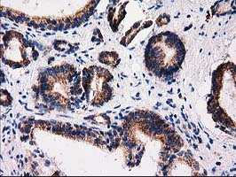 FAM127C Antibody - IHC of paraffin-embedded Carcinoma of Human prostate tissue using anti-FAM127C mouse monoclonal antibody.