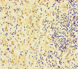 FAM127C Antibody - Immunohistochemistry of paraffin-embedded human lung cancer using FAM127C Antibody at dilution of 1:100