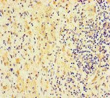 FAM127C Antibody - Immunohistochemistry of paraffin-embedded human lung cancer using FAM127C Antibody at dilution of 1:100