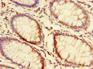 FAM131A Antibody - Immunohistochemistry of paraffin-embedded human colon cancer using FAM131A Antibody at dilution of 1:100
