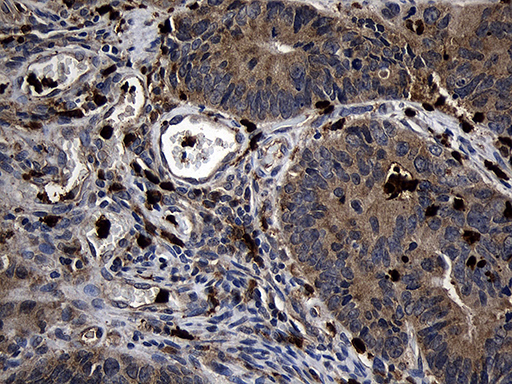 FAM131C Antibody - Immunohistochemical staining of paraffin-embedded Adenocarcinoma of Human colon tissue using anti-FAM131C mouse monoclonal antibody. (Heat-induced epitope retrieval by 1mM EDTA in 10mM Tris buffer. (pH8.5) at 120°C for 3 min. (1:500)