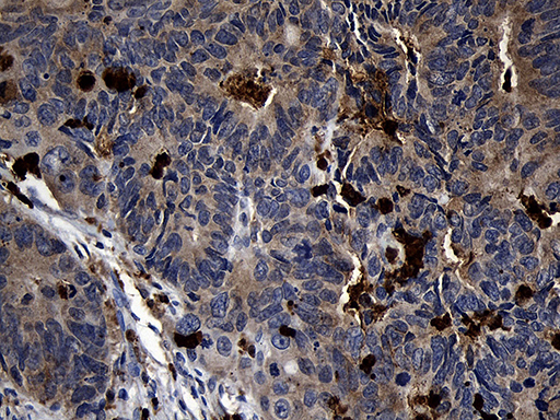 FAM131C Antibody - Immunohistochemical staining of paraffin-embedded Adenocarcinoma of Human colon tissue using anti-FAM131C mouse monoclonal antibody. (Heat-induced epitope retrieval by 1mM EDTA in 10mM Tris buffer. (pH8.5) at 120°C for 3 min. (1:500)