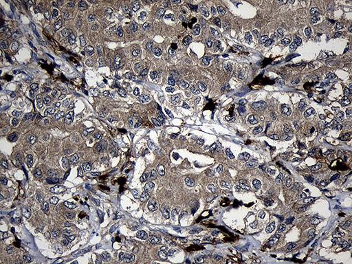 FAM131C Antibody - Immunohistochemical staining of paraffin-embedded Carcinoma of Human liver tissue using anti-FAM131C mouse monoclonal antibody. (Heat-induced epitope retrieval by 1mM EDTA in 10mM Tris buffer. (pH8.5) at 120°C for 3 min. (1:500)