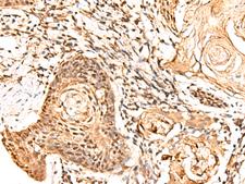 FAM134B Antibody - Immunohistochemistry of paraffin-embedded Human esophagus cancer tissue  using RETREG1 Polyclonal Antibody at dilution of 1:60(×200)