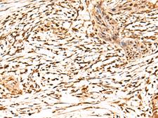 FAM134B Antibody - Immunohistochemistry of paraffin-embedded Human esophagus cancer tissue  using RETREG1 Polyclonal Antibody at dilution of 1:50(×200)