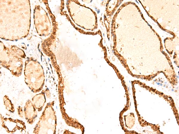 FAM134B Antibody - Immunohistochemistry of paraffin-embedded Human thyroid cancer tissue  using RETREG1 Polyclonal Antibody at dilution of 1:50(×200)