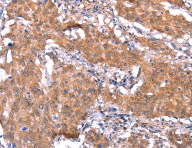 FAM13B Antibody - Immunohistochemistry of paraffin-embedded Human gastric cancer using FAM13B Polyclonal Antibody at dilution of 1:30.