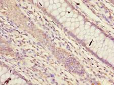 FAM149B1 Antibody - Immunohistochemistry of paraffin-embedded human colon cancer using antibody at dilution of 1:100.