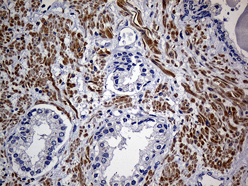 FAM151B Antibody - Immunohistochemical staining of paraffin-embedded Human prostate tissue within the normal limits using anti-FAM151B mouse monoclonal antibody. (Heat-induced epitope retrieval by 1mM EDTA in 10mM Tris buffer. (pH8.5) at 120°C for 3 min. (1:500)