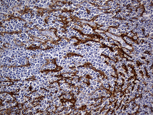 FAM151B Antibody - Immunohistochemical staining of paraffin-embedded Human lymphoma tissue using anti-FAM151B mouse monoclonal antibody. (Heat-induced epitope retrieval by 1mM EDTA in 10mM Tris buffer. (pH8.5) at 120°C for 3 min. (1:500)