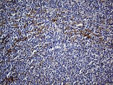 FAM151B Antibody - Immunohistochemical staining of paraffin-embedded Human lymphoma tissue using anti-FAM151B mouse monoclonal antibody. (Heat-induced epitope retrieval by 1mM EDTA in 10mM Tris buffer. (pH8.5) at 120°C for 3 min. (1:500)