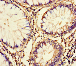 FAM161A Antibody - Immunohistochemistry of paraffin-embedded human colon cancer using FAM161A Antibody at dilution of 1:100