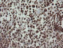 FAM164A / CGI-62 Antibody - IHC of paraffin-embedded Carcinoma of Human bladder tissue using anti-FAM164A mouse monoclonal antibody.
