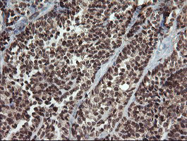FAM164A / CGI-62 Antibody - IHC of paraffin-embedded Carcinoma of Human thyroid tissue using anti-FAM164A mouse monoclonal antibody.