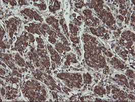FAM164A / CGI-62 Antibody - IHC of paraffin-embedded Carcinoma of Human liver tissue using anti-FAM164A mouse monoclonal antibody.