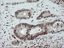 FAM164A / CGI-62 Antibody - IHC of paraffin-embedded Adenocarcinoma of Human colon tissue using anti-FAM164A mouse monoclonal antibody.