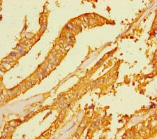 FAM167A Antibody - Immunohistochemistry of paraffin-embedded human endometrial cancer using FAM167A Antibody at dilution of 1:100