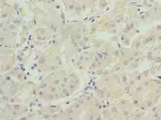 FAM168B Antibody - Immunohistochemistry of paraffin-embedded human gastric cancer using antibody at dilution of 1:100.