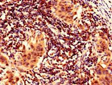 FAM171B Antibody - Immunohistochemistry analysis of human bladder cancer using FAM171B Antibody at dilution of 1:100