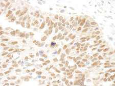 FAM175A / CCDC98 Antibody - Detection of Human Abraxas by Immunohistochemistry. Sample: FFPE section of human ovarian carcinoma. Antibody: Affinity purified rabbit anti-Abraxas used at a dilution of 1:250.