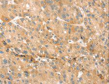 FAM176A / TMEM166 Antibody - Immunohistochemistry of paraffin-embedded Human liver cancer using EVA1A Polyclonal Antibody at dilution of 1:30.