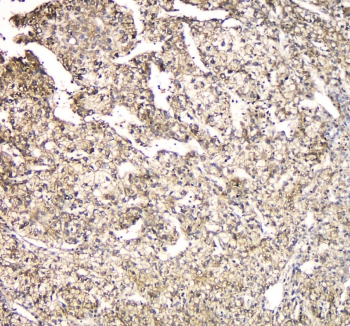 FAM176A / TMEM166 Antibody - IHC staining of FFPE human liver cancer with TMEM166 antibody at 1ug/ml. HIER: boil tissue sections in pH6, 10mM citrate buffer, for 10-20 min and allow to cool before testing.