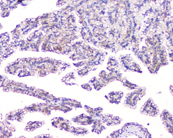 FAM176A / TMEM166 Antibody - IHC staining of FFPE human renal cancer with TMEM166 antibody at 1ug/ml. HIER: boil tissue sections in pH6, 10mM citrate buffer, for 10-20 min and allow to cool before testing.