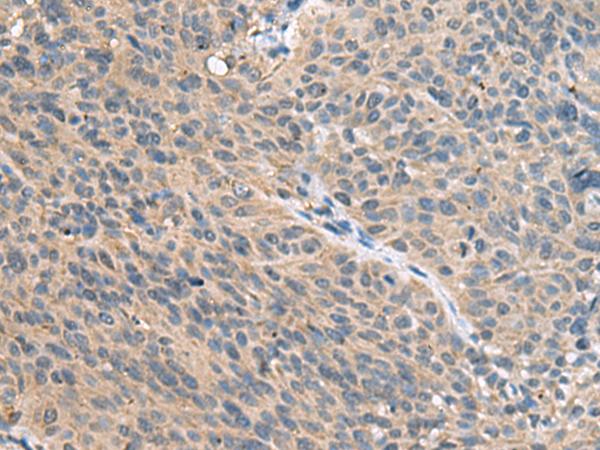 FAM19A4 Antibody - Immunohistochemistry of paraffin-embedded Human cervical cancer tissue  using FAM19A4 Polyclonal Antibody at dilution of 1:55(×200)