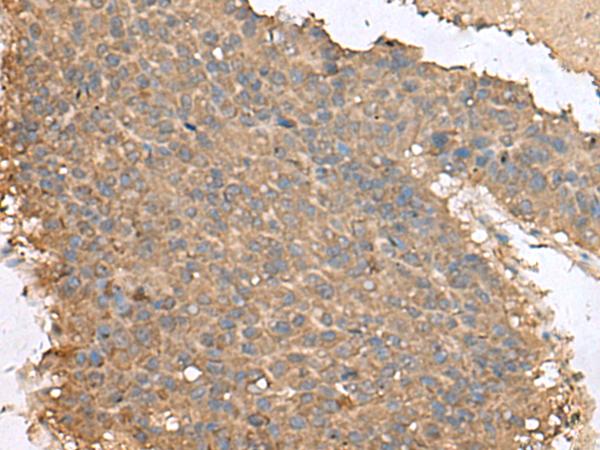 FAM19A4 Antibody - Immunohistochemistry of paraffin-embedded Human liver cancer tissue  using FAM19A4 Polyclonal Antibody at dilution of 1:65(×200)