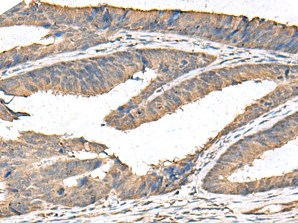 FAM19A4 Antibody - Immunohistochemistry of paraffin-embedded Human colorectal cancer tissue  using FAM19A4 Polyclonal Antibody at dilution of 1:65(×200)