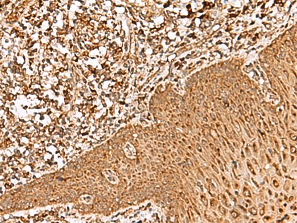 FAM200A Antibody - Immunohistochemistry of paraffin-embedded Human esophagus cancer tissue  using FAM200A Polyclonal Antibody at dilution of 1:55(×200)