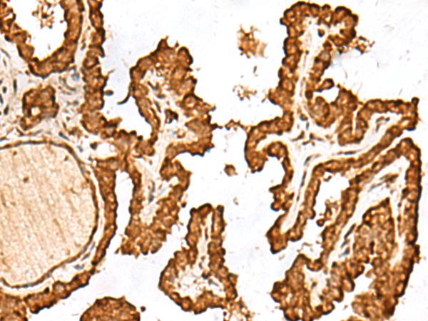 FAM200A Antibody - Immunohistochemistry of paraffin-embedded Human thyroid cancer tissue  using FAM200A Polyclonal Antibody at dilution of 1:55(×200)