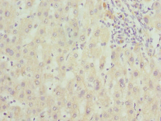FAM20A Antibody - Immunohistochemistry of paraffin-embedded human liver cancer at dilution 1:100