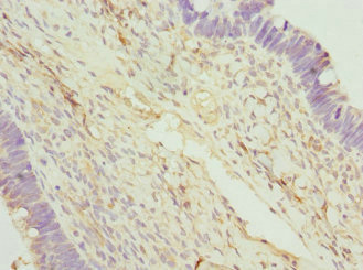 FAM20A Antibody - Immunohistochemistry of paraffin-embedded human ovarian cancer at dilution 1:100