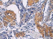 FAM20C Antibody - Immunohistochemistry of paraffin-embedded Human esophagus cancer tissue  using FAM20C Polyclonal Antibody at dilution of 1:45(×200)