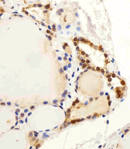 FAM216B Antibody - Immunohistochemical of paraffin-embedded H.thyroid section using C13orf30 Antibody. Antibody was diluted at 1:25 dilution. A peroxidase-conjugated goat anti-rabbit IgG at 1:400 dilution was used as the secondary antibody, followed by DAB staining.
