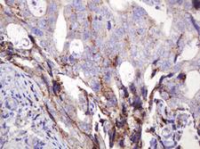 FAM234A Antibody - IHC of paraffin-embedded Adenocarcinoma of Human breast tissue using anti-ITFG3 mouse monoclonal antibody.