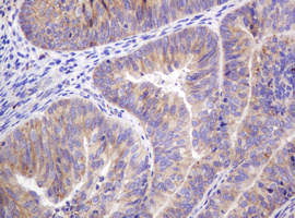 FAM234A Antibody - IHC of paraffin-embedded Adenocarcinoma of Human endometrium tissue using anti-ITFG3 mouse monoclonal antibody.