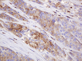 FAM234A Antibody - IHC of paraffin-embedded Adenocarcinoma of Human colon tissue using anti-ITFG3 mouse monoclonal antibody.