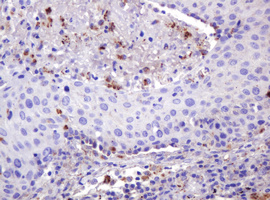 FAM234A Antibody - IHC of paraffin-embedded Carcinoma of Human lung tissue using anti-ITFG3 mouse monoclonal antibody.