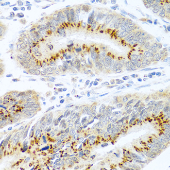 FAM3B Antibody - Immunohistochemistry of paraffin-embedded human colon carcinoma using FAM3B antibodyat dilution of 1:100 (40x lens).