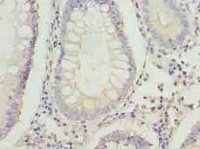 FAM3B Antibody - Immunohistochemistry of paraffin-embedded human colon cancer using antibody at dilution of 1:100.