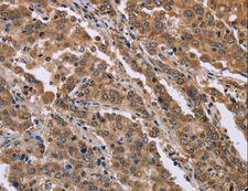 FAM3B Antibody - Immunohistochemistry of paraffin-embedded Human liver cancer using FAM3B Polyclonal Antibody at dilution of 1:40.
