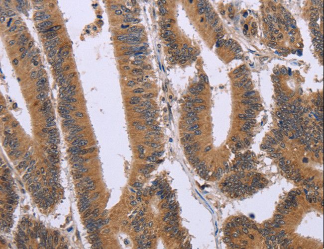 FAM3B Antibody - Immunohistochemistry of paraffin-embedded Human colon cancer using FAM3B Polyclonal Antibody at dilution of 1:30.