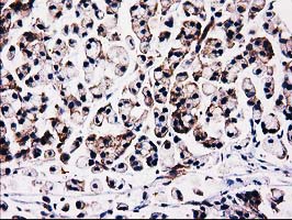FAM40A Antibody - IHC of paraffin-embedded Adenocarcinoma of Human colon tissue using anti-FAM40A mouse monoclonal antibody.